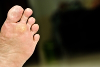 What Is Cryotherapy for Foot Warts?