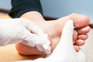 The Basics on Plantar Warts
