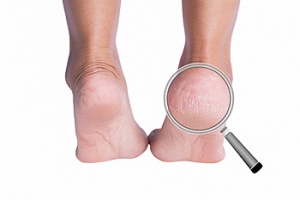 Cracked Heels and Socks