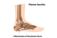 Plantar Fasciitis and the Back