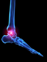 Types of Arthritis That May Affect the Feet