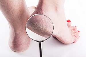 How to Avoid Cracked Heels