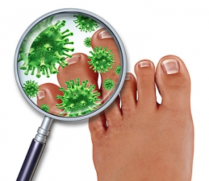 Possible Treatment of Athlete’s Foot