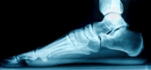 How to Diagnose Flat Feet