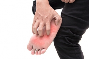Athlete&#039;s Foot Is Contagious