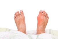 Painful Symptoms of Gout