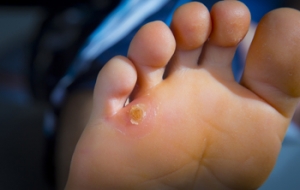 Treatment for Corns on the Feet