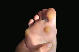 Common Signs Of Plantar Warts